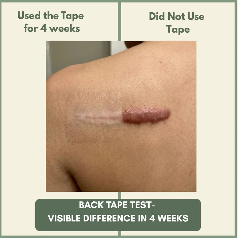 TheAvelon™ Medical-Grade Silicone Scar Therapy Roll