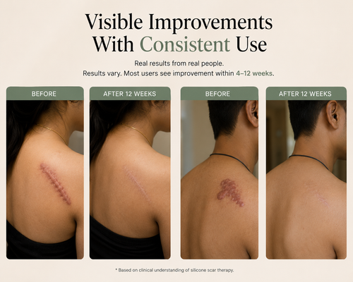 TheAvelon™ Silicone Scar Therapy Tape
