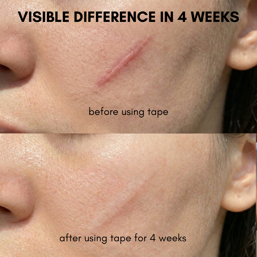 TheAvelon™ Medical-Grade Silicone Scar Therapy Roll