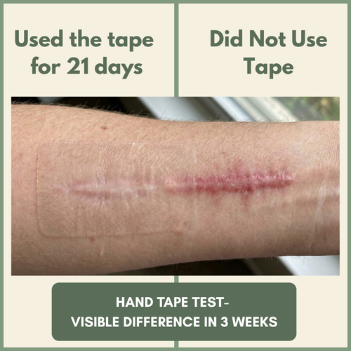 TheAvelon™ Medical-Grade Silicone Scar Therapy Roll